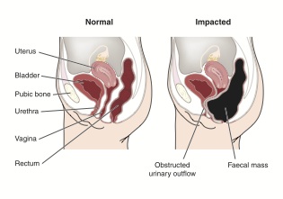 Constipationdiagram.jpg