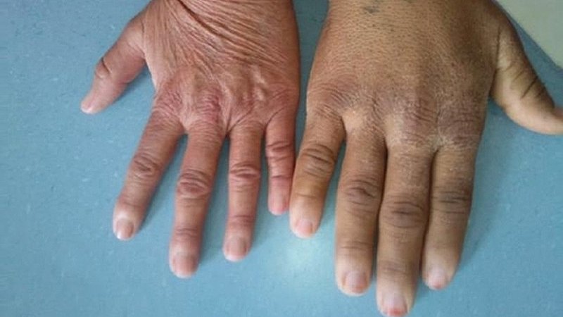 Image result for Acromegaly