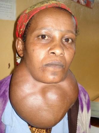 Image result for goiter